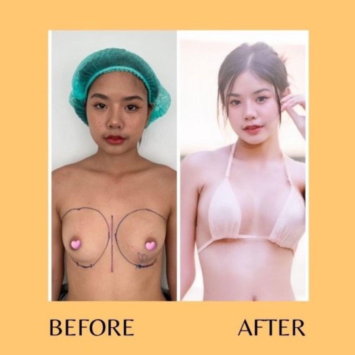 Before and after breast augmentation with silicone implants results at ID Clinic Bangkok