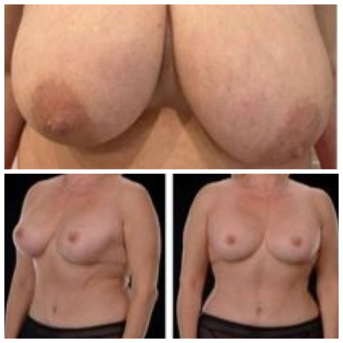 نتائج تصغير الثدي قبل وبعد في Yurchenko Plastic Surgery Team، تحسين الشكل