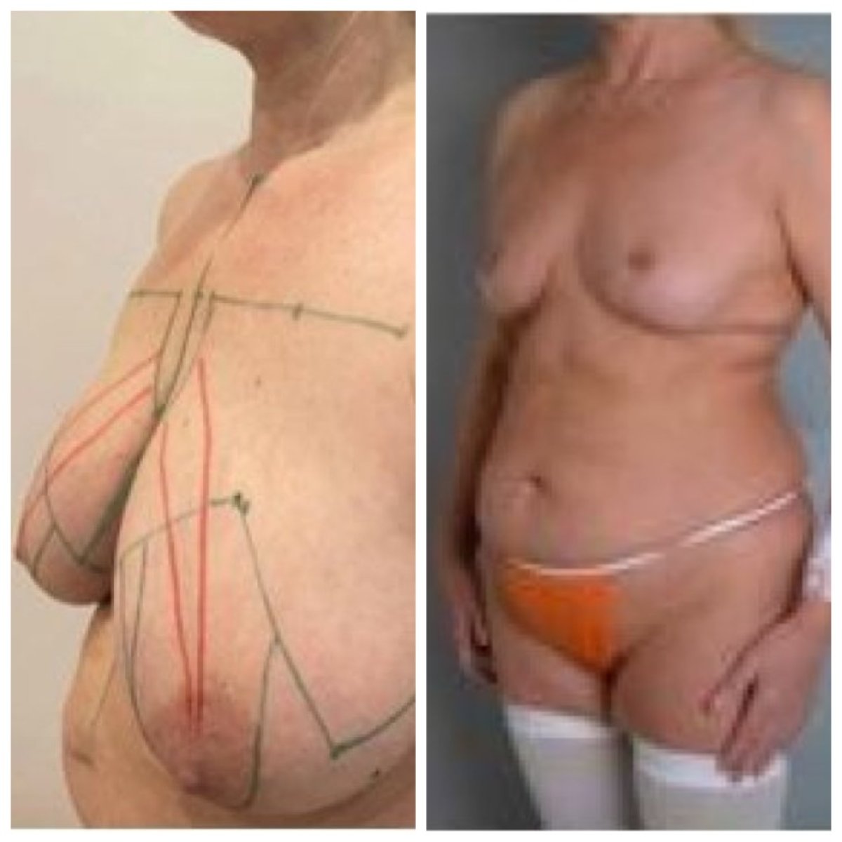 نتائج تصغير الثدي قبل وبعد في Yurchenko Plastic Surgery Team، تحسين الشكل