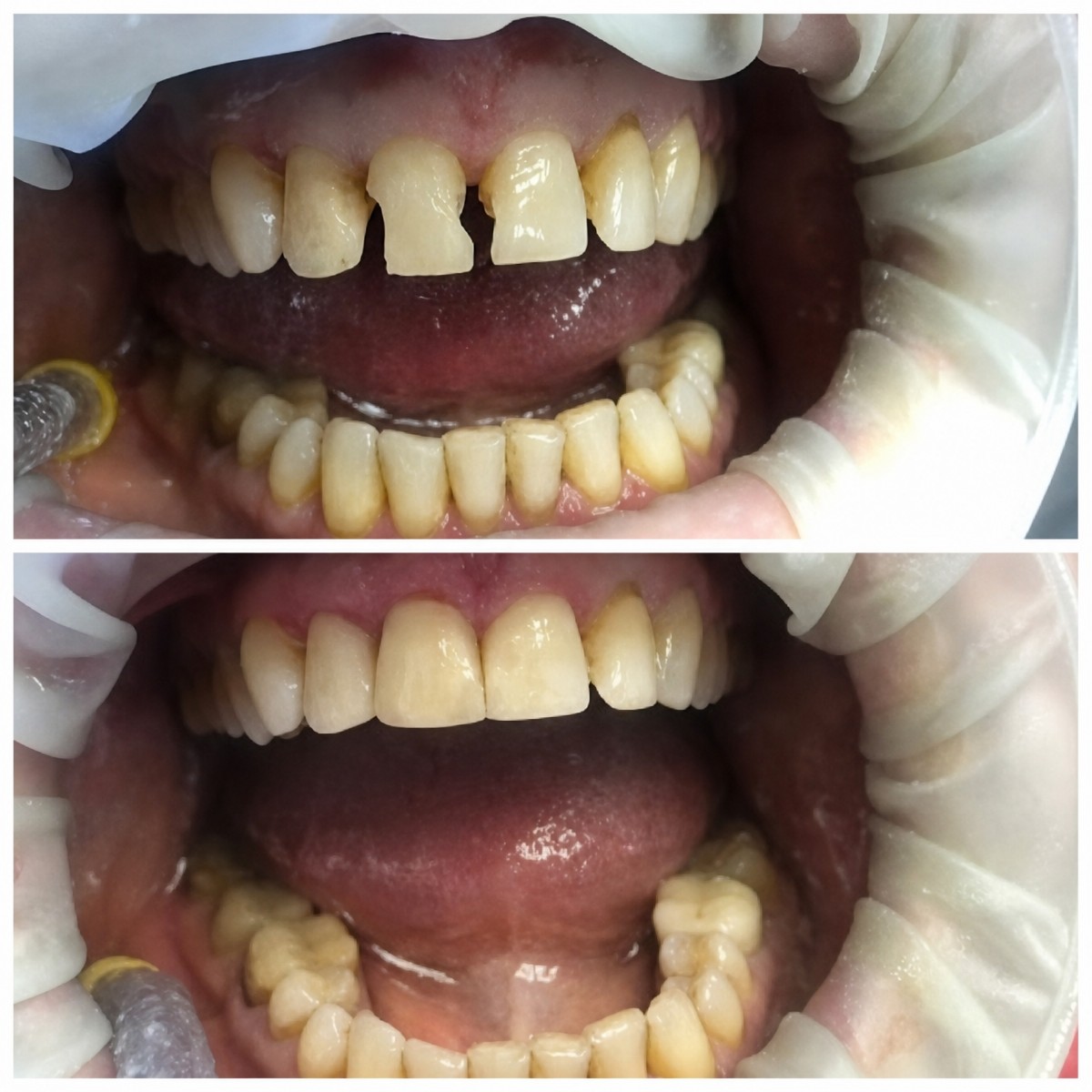 نتائج قبل وبعد تركيب تيجان الأسنان في Casa Dental, s.r.o. لاستعادة الابتسامة