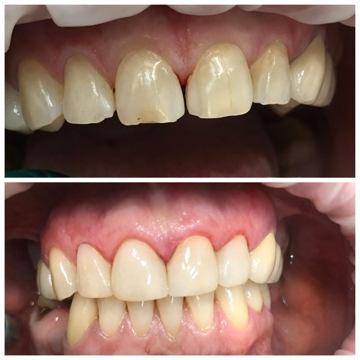Résultats avant/après pose de couronnes dentaires chez Casa Dental, s.r.o. – sourire amélioré