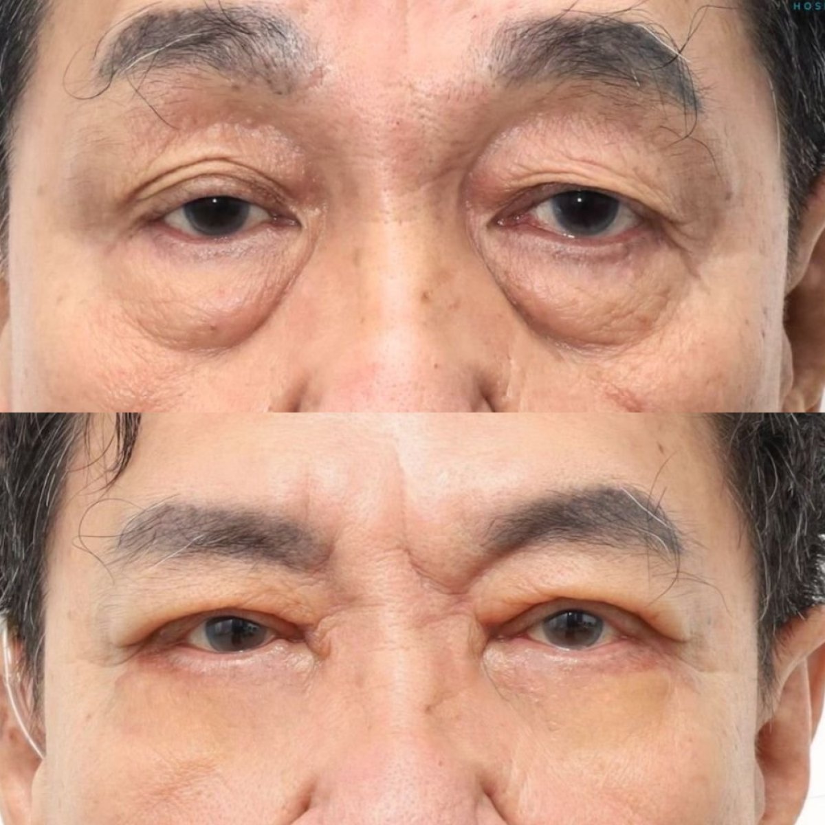 Résultats avant/après blépharoplastie supérieure et inférieure à Wansiri Hospital, yeux rajeunis
