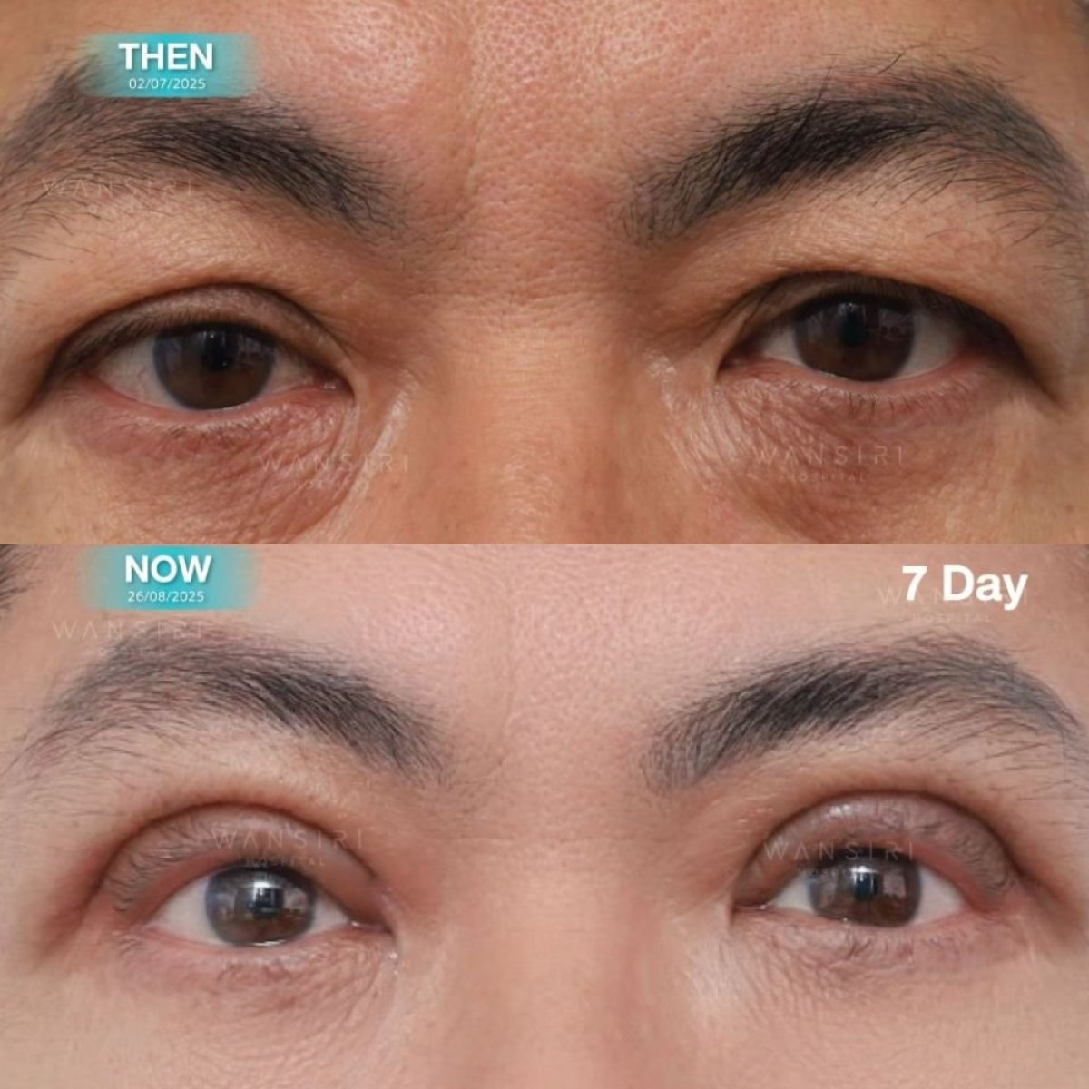 Before and after upper and lower eyelid surgery results at Wansiri Hospital, 7 days post-op