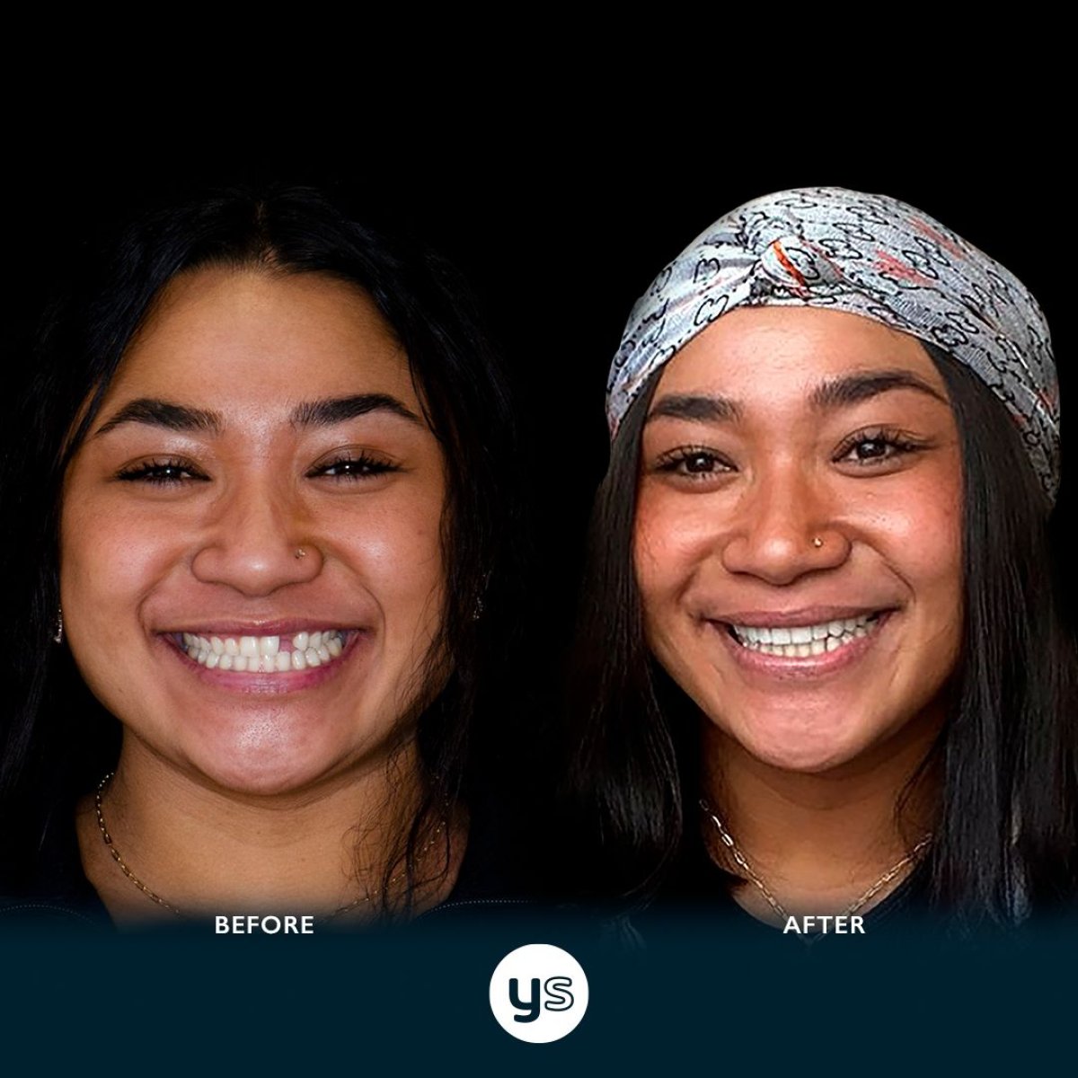 Resultados de implantes dentales antes y después en YeahSmile: sonrisa mejorada y natural