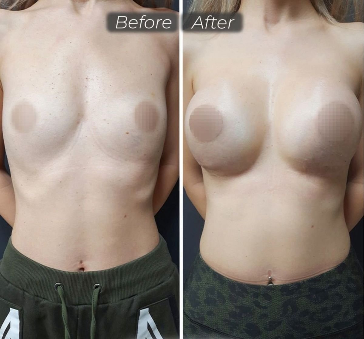 Before and after breast augmentation results at Dr. Safa Manav Clinic, enhanced breast shape