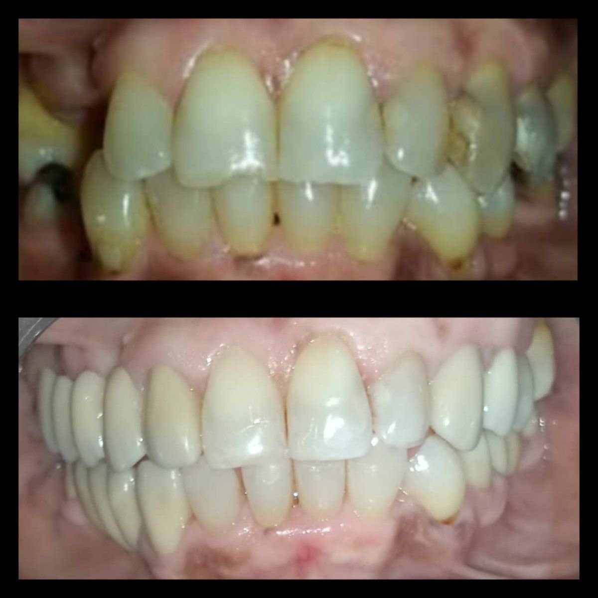 Before and after gum surgery results at Dra Zoila Fernández's Private Practice, improved gums