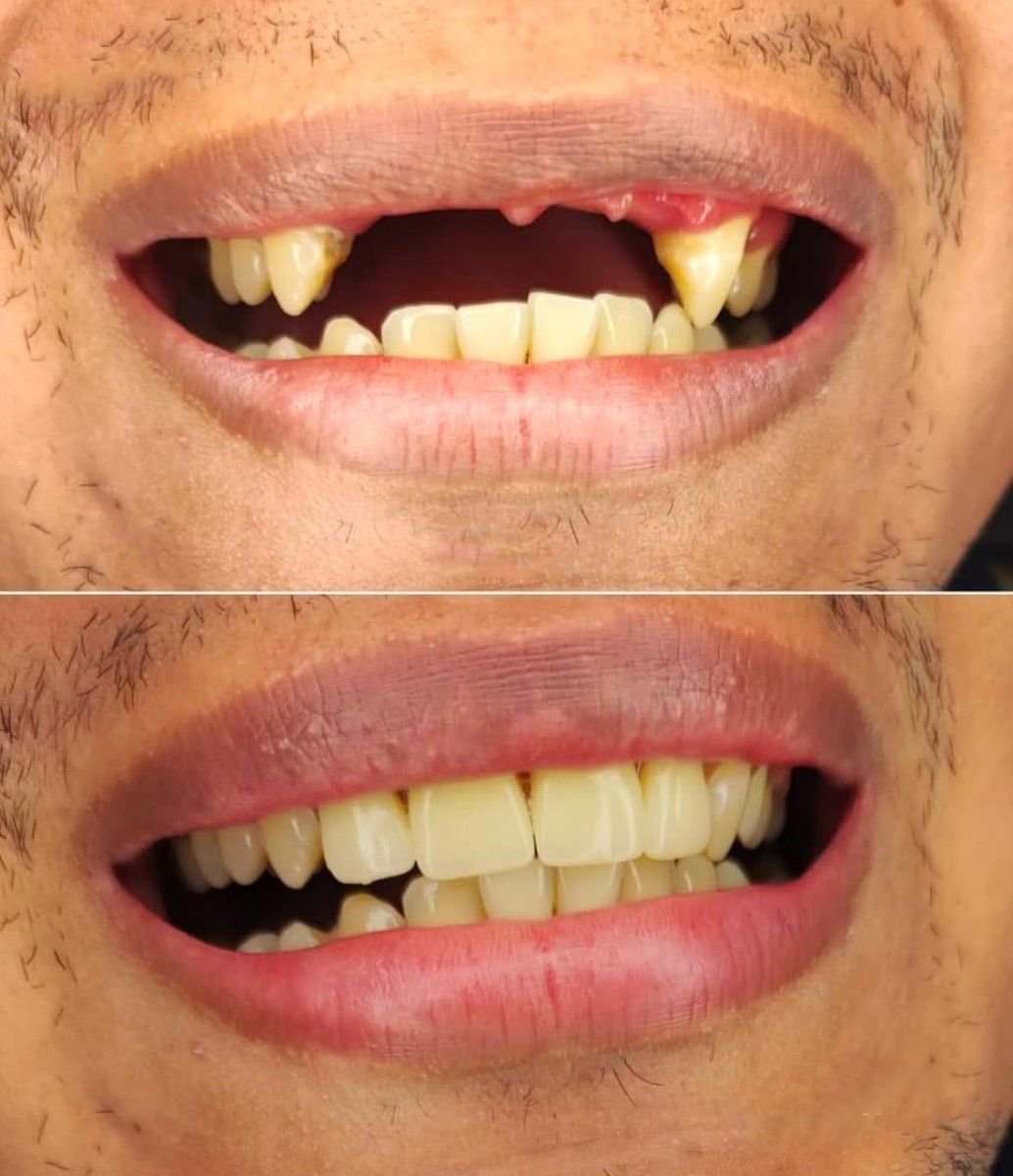 Before and after All-on-6 dental implants result at Love Dental and Sthetic Clinic, restored smile