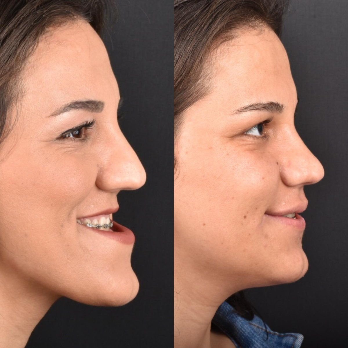 Результаты до и после коррекции челюсти в Dentavie Istanbul Dental Clinic, улучшен профиль