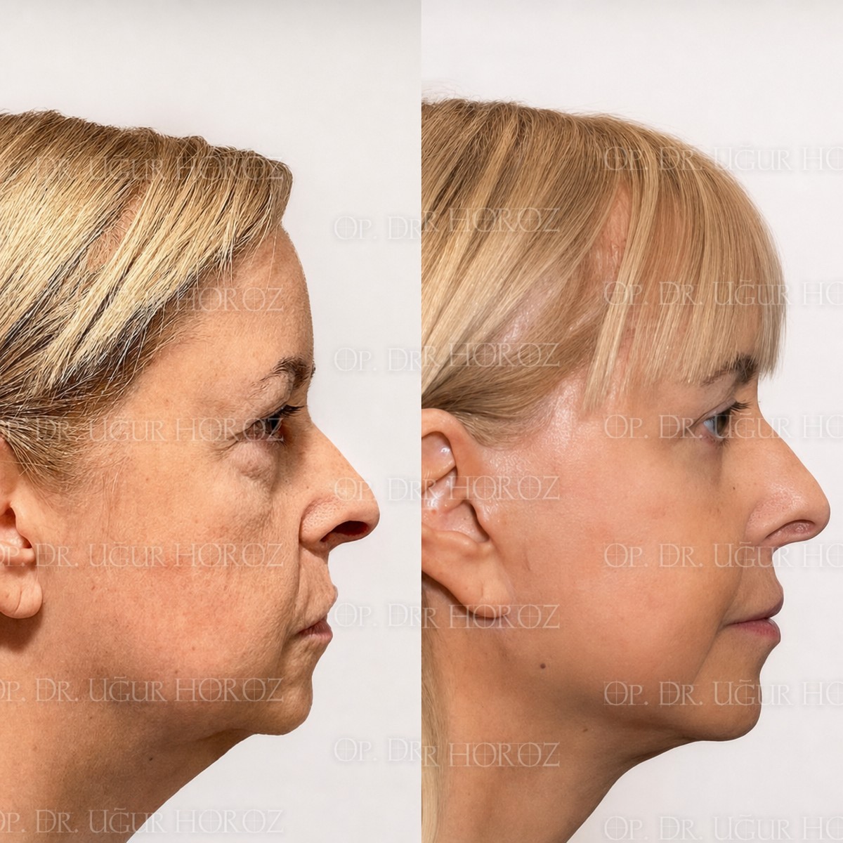 Resultados de lifting de cejas antes y después en Dr. MED – rejuvenecimiento visible