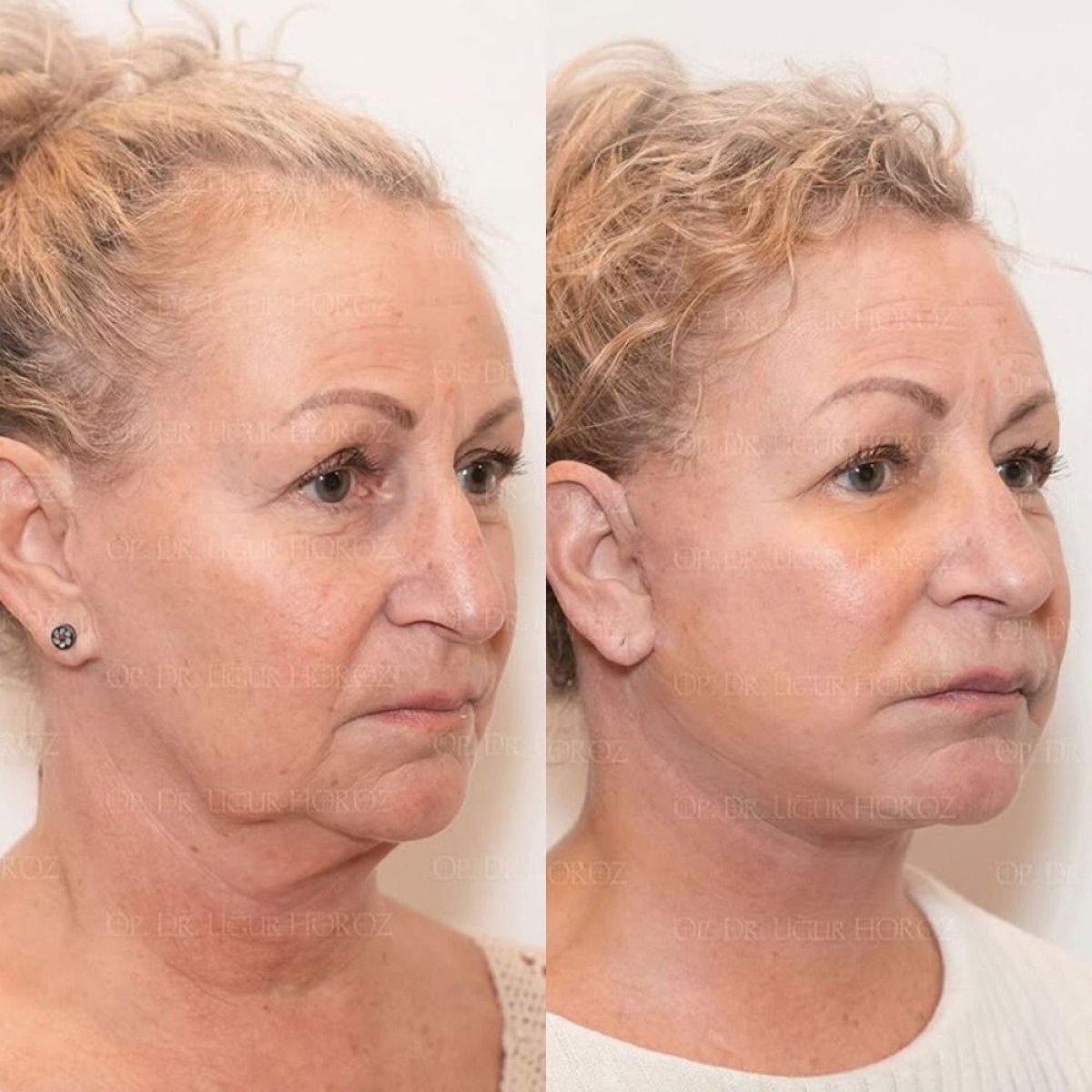 Résultats avant/après lifting des sourcils chez Dr. MED – rajeunissement visible du front