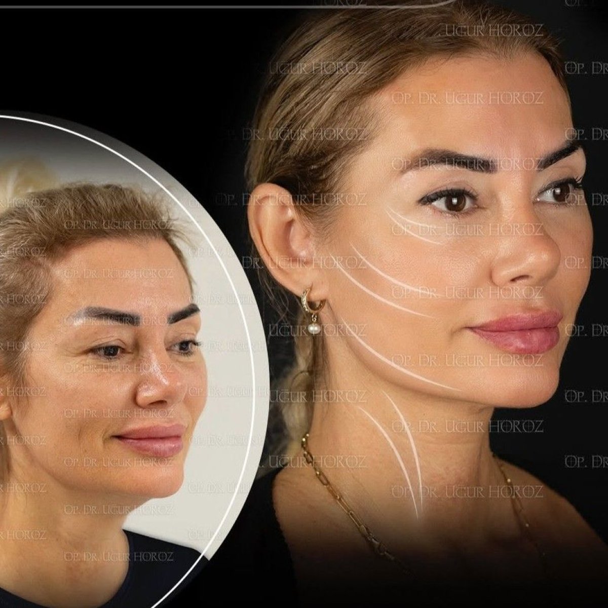 Resultados de lifting de cejas antes y después en Dr. MED – mejora visible en cejas y frente