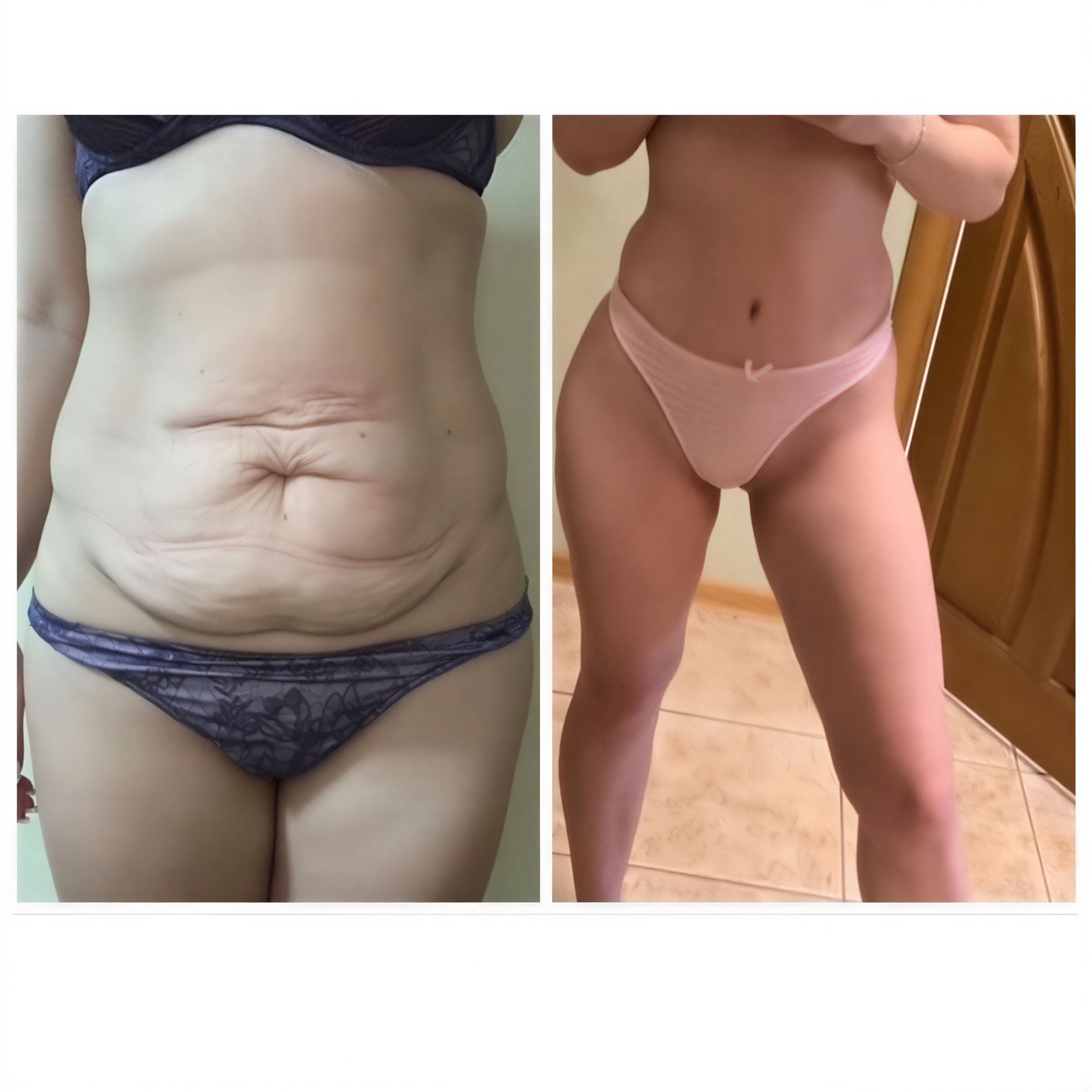 Resultados antes y después de abdominoplastia y liposucción en Dmytrii Homola Clinic, abdomen plano