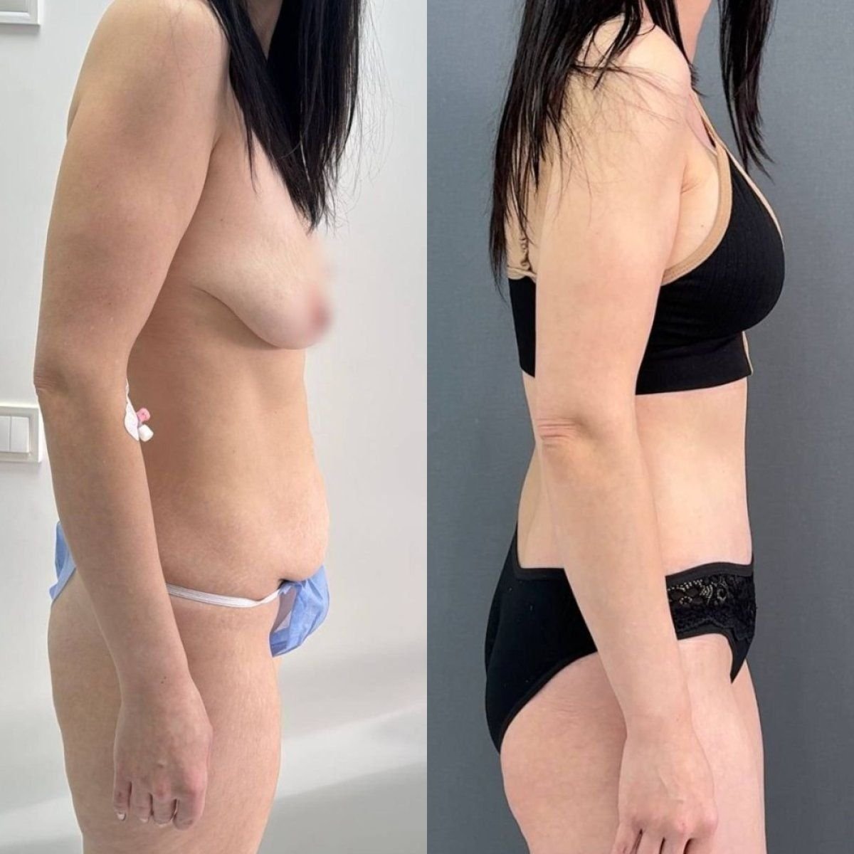 Before and after tummy tuck and liposuction results at Dmytrii Homola Clinic, flatter abdomen