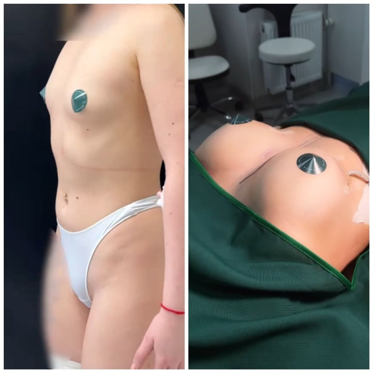 نتائج شد الثدي قبل وبعد في عيادة دميتري هومولا، تحسين واضح لشكل الثدي