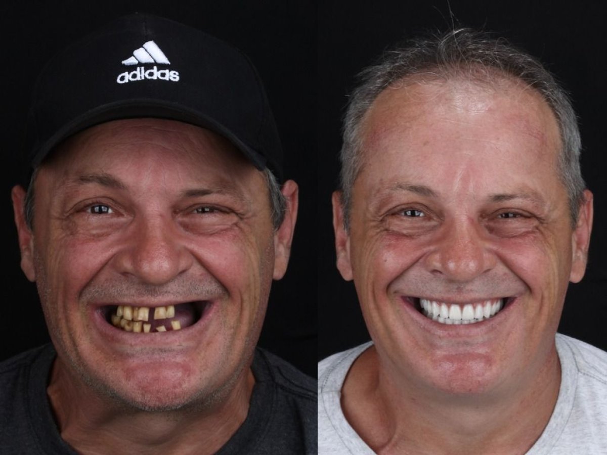 Before and after All-on-6 dental implants result at European Valley Health, smile restoration