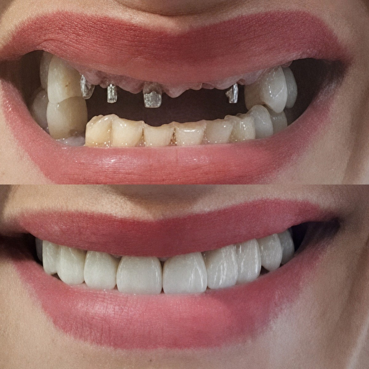 نتيجة قبل وبعد زراعة الأسنان All-on-4 في Hospitadent Dental Group - Alanya Clinic