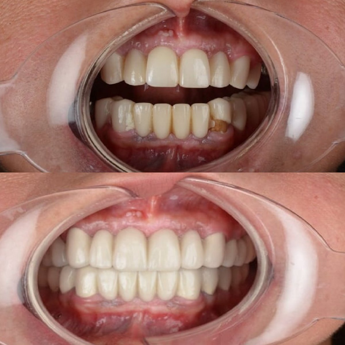 Before and after dental crown installation results at Hospitadent Dental Group - Alanya Clinic