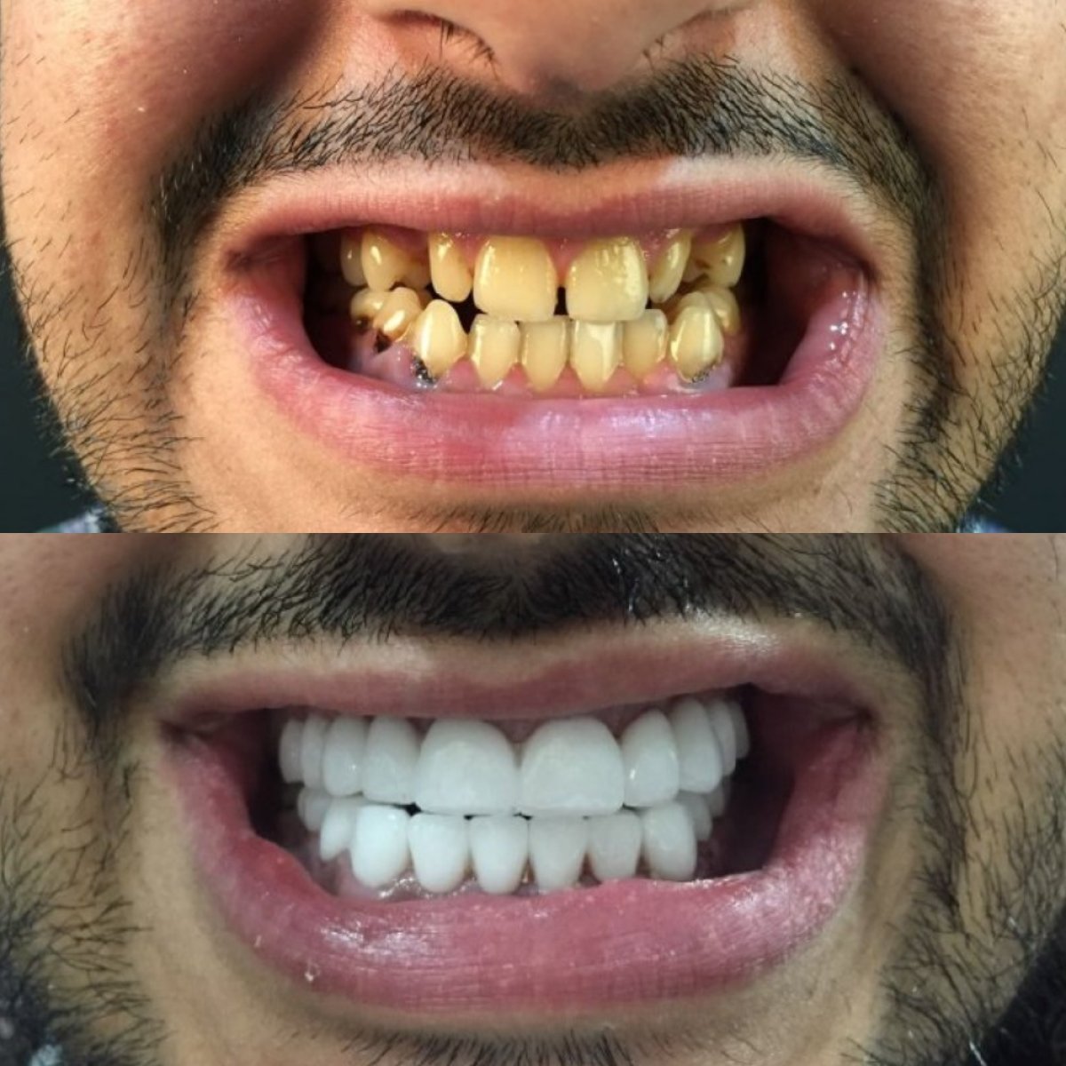 Before and after dental crown installation results at Hospitadent Dental Group - Alanya Clinic