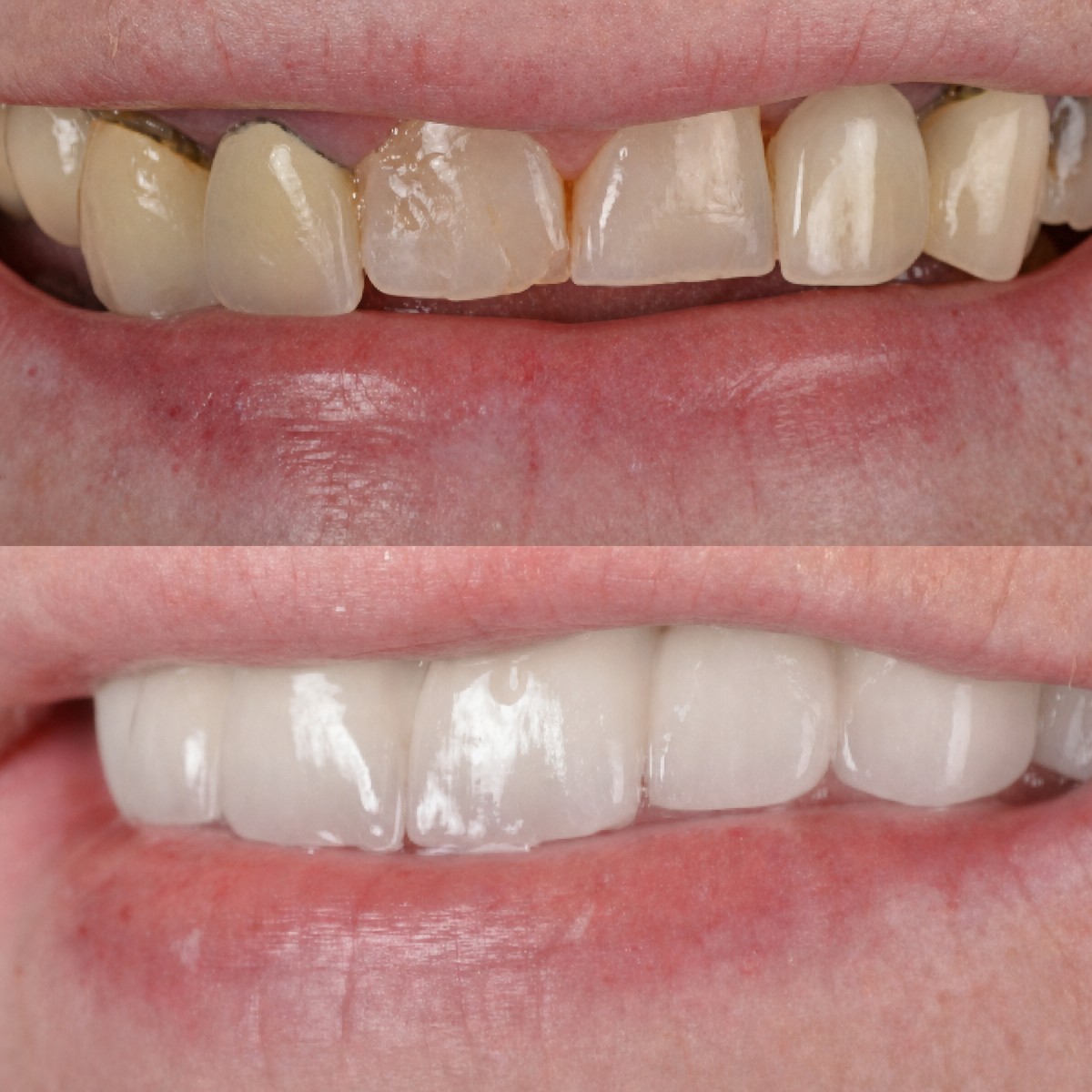 نتائج قبل وبعد تركيب تيجان الأسنان في Hospitadent Dental Group - Alanya Clinic