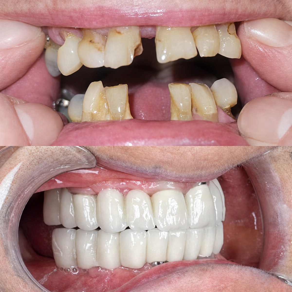 Before and after dental implant results at Hospitadent Dental Group - Alanya Clinic, smile restored