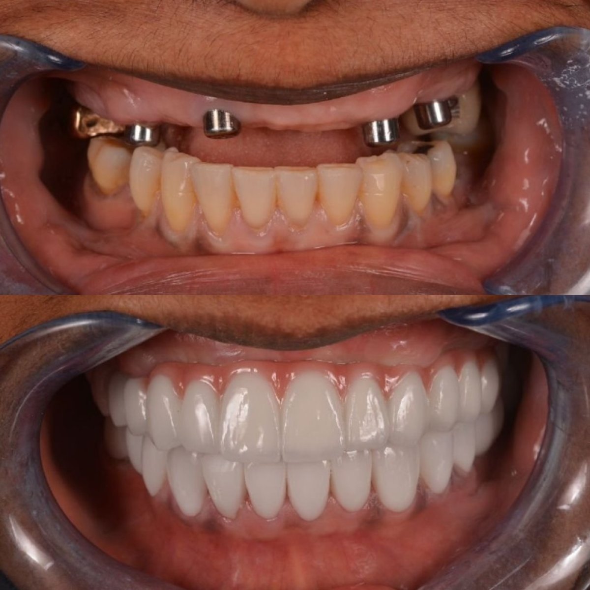 نتائج قبل وبعد زراعة الأسنان في Hospitadent Dental Group - Alanya Clinic، استعادة الابتسامة