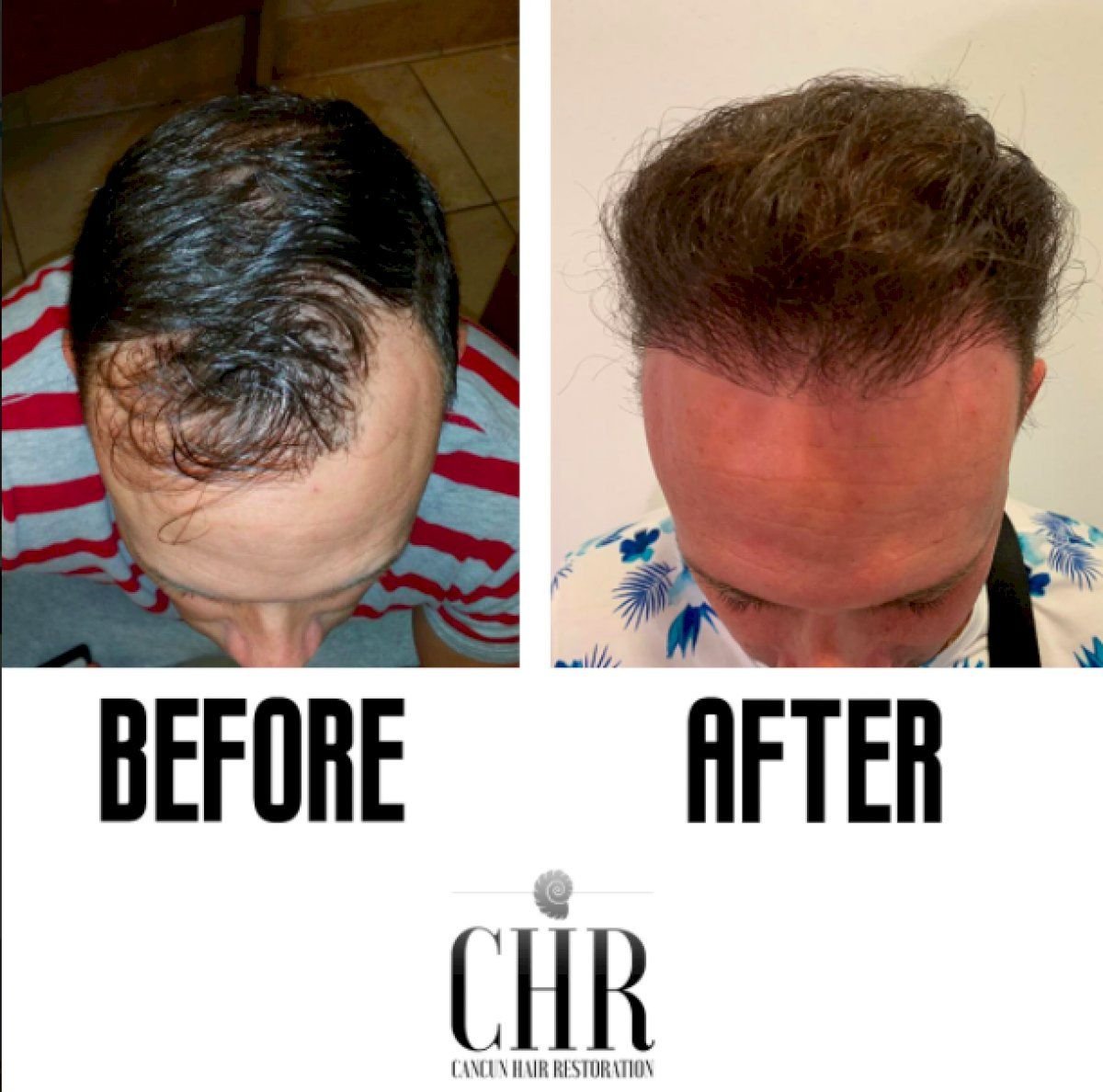 Resultados antes y después de trasplante capilar FUE en Cancun Hair Restoration, línea mejorada