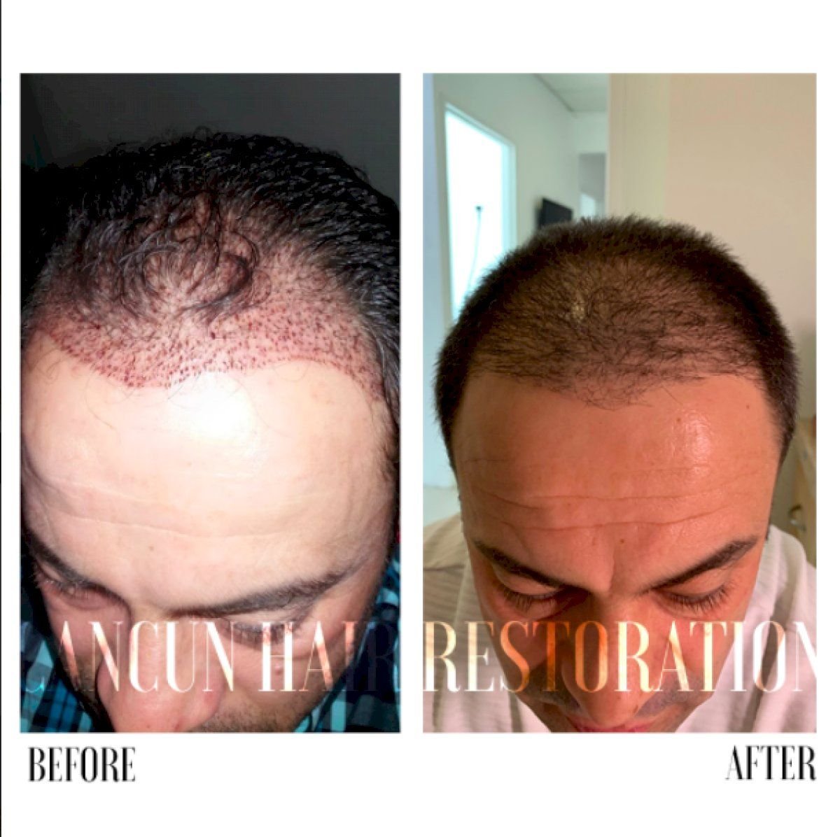Resultados antes y después de trasplante capilar FUE en Cancun Hair Restoration, línea mejorada