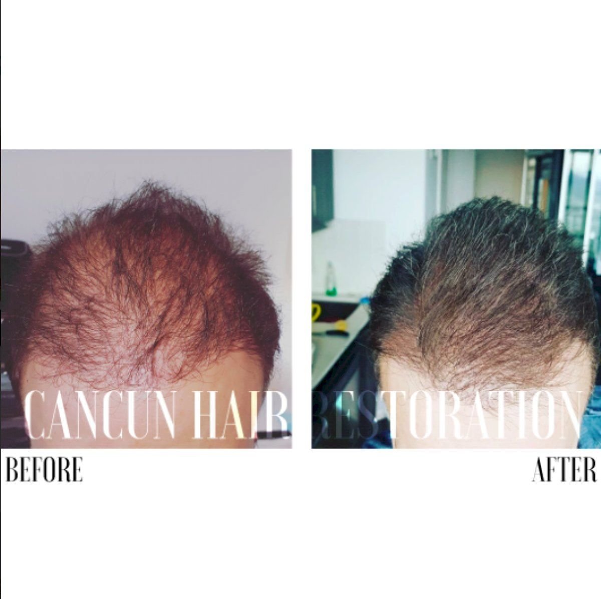 Resultados antes y después de trasplante capilar FUE en Cancun Hair Restoration, mayor densidad