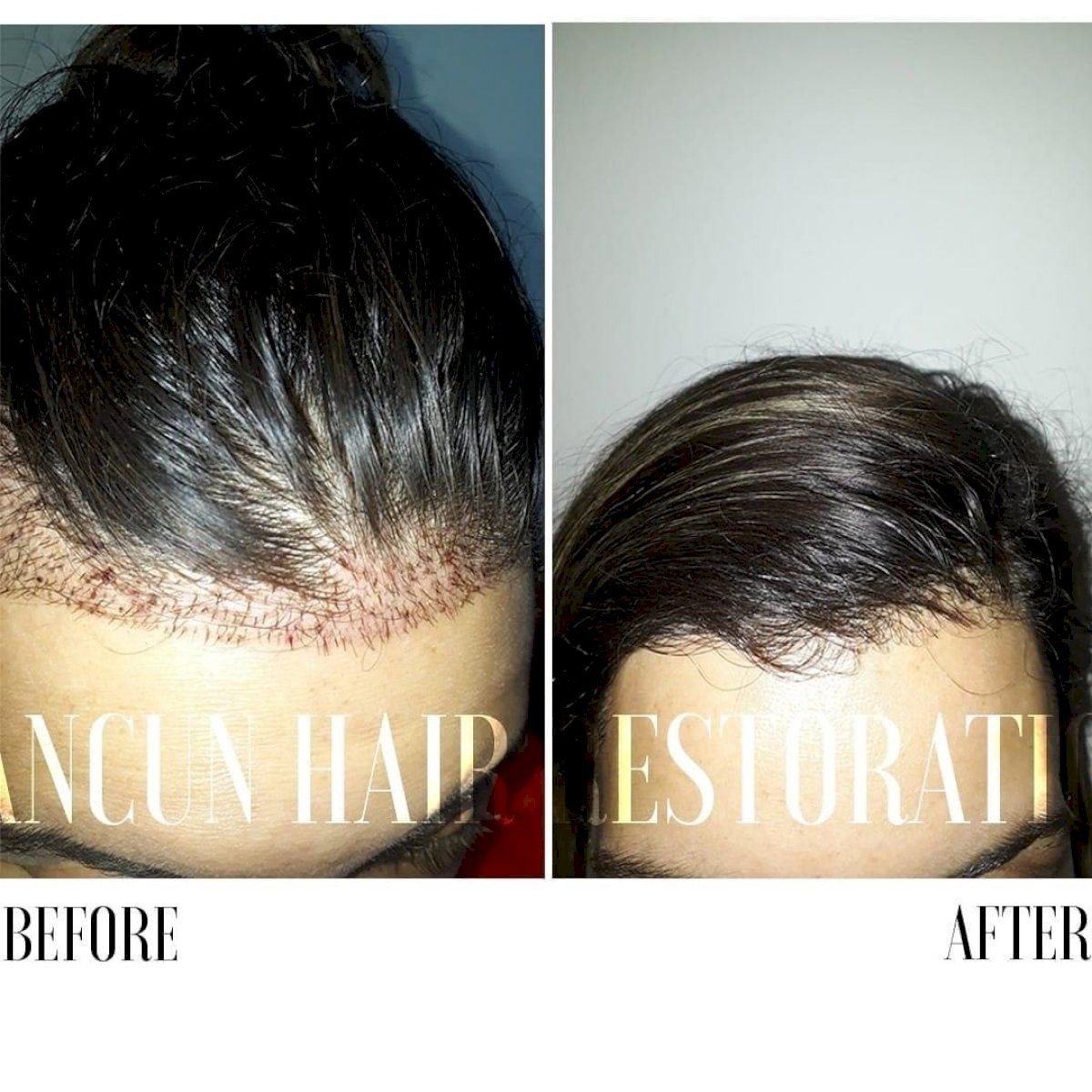 Resultados antes y después de trasplante capilar FUE en Cancun Hair Restoration, línea mejorada
