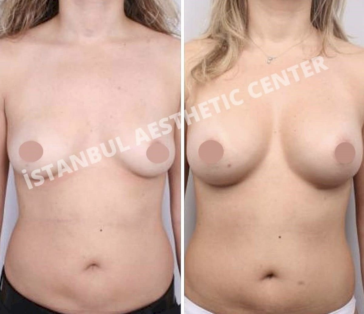 Результаты до и после увеличения груди с подтяжкой в Istanbul Aesthetic Plastic Surgery Center