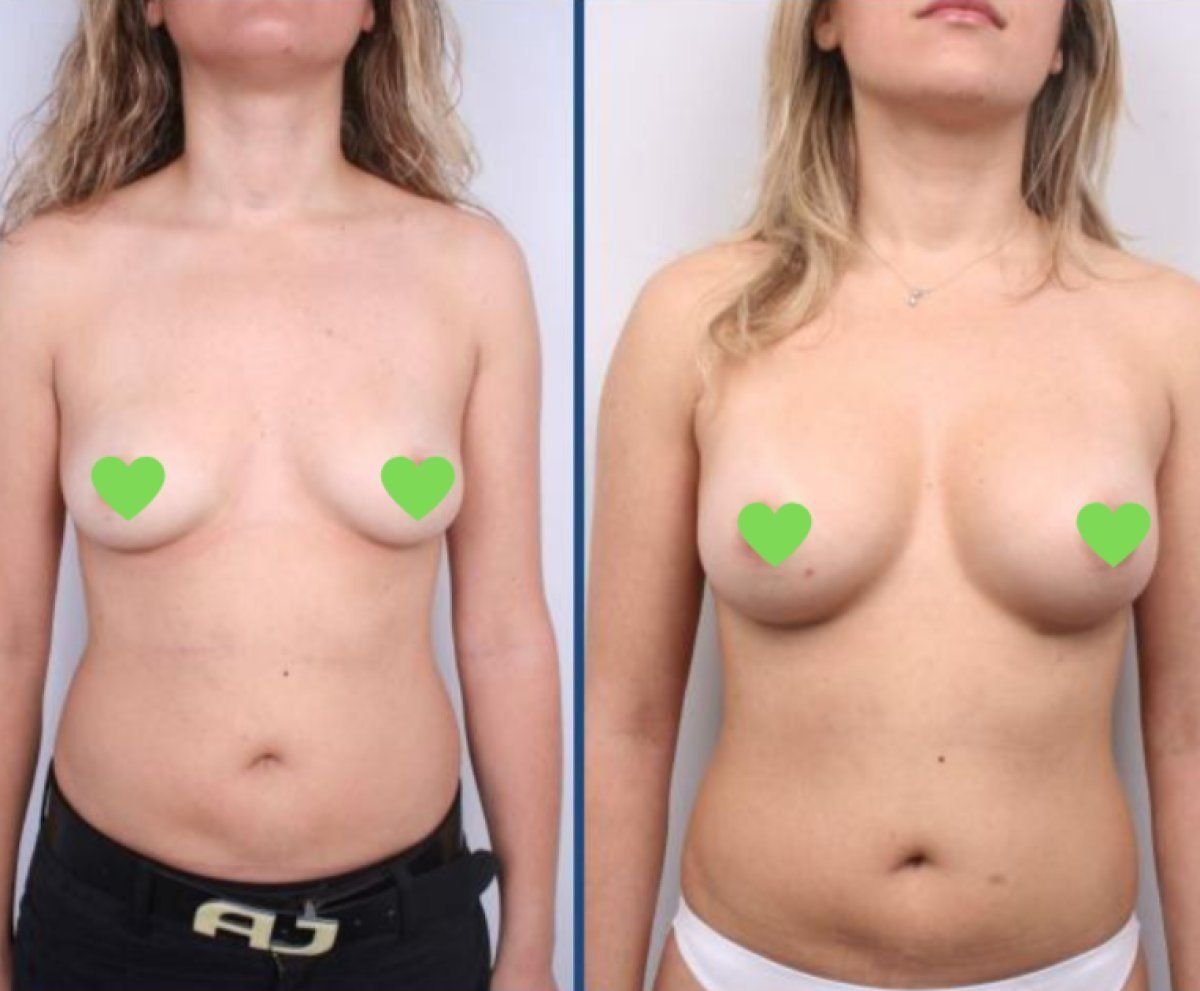 Результаты до и после увеличения и подтяжки груди в Istanbul Aesthetic Plastic Surgery Center