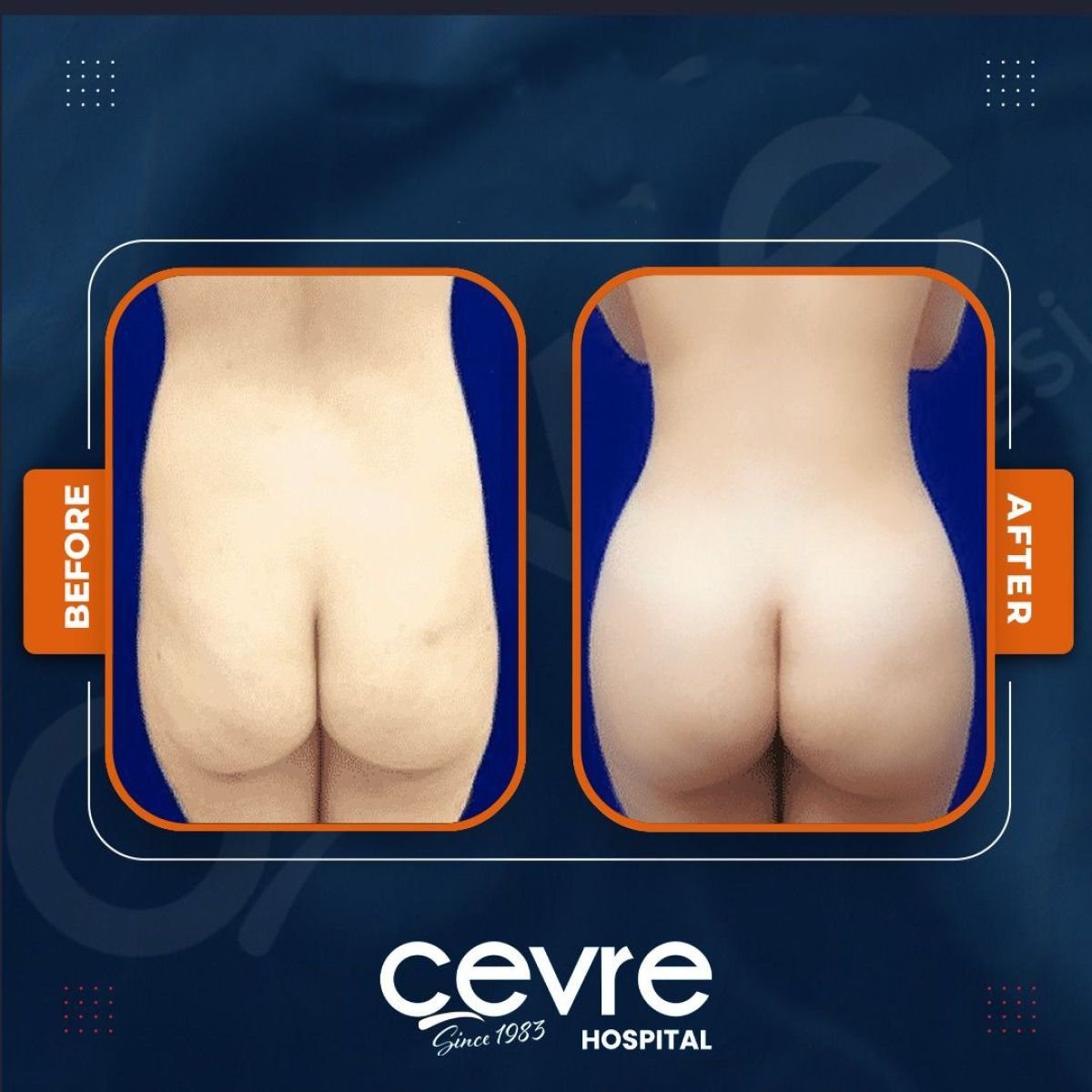 نتائج قبل وبعد عملية Brazilian Butt Lift في Adem and Havva Medical Center، تحسين الشكل