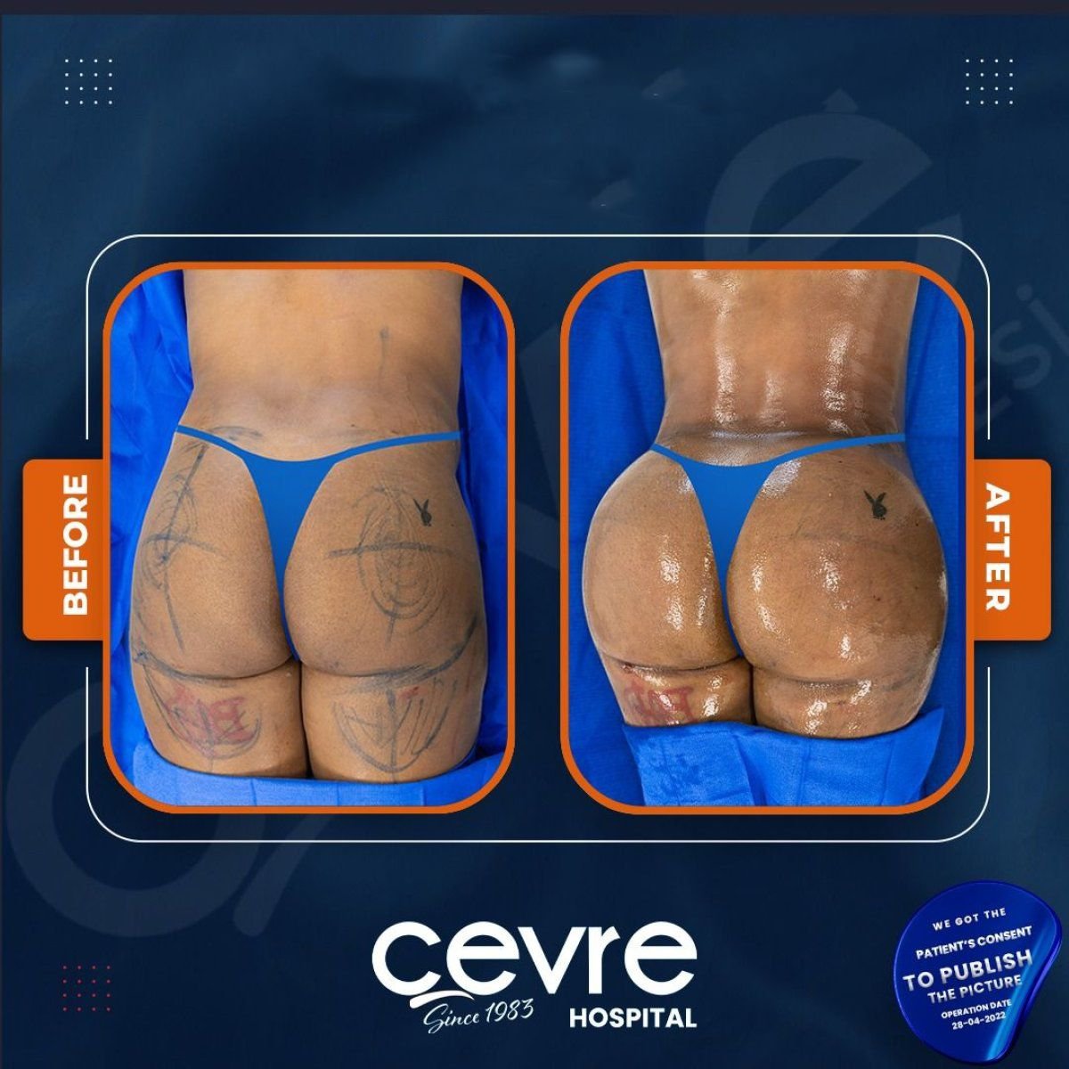 نتائج قبل وبعد عملية Brazilian Butt Lift في Cevre Hospital، تحسين شكل الأرداف