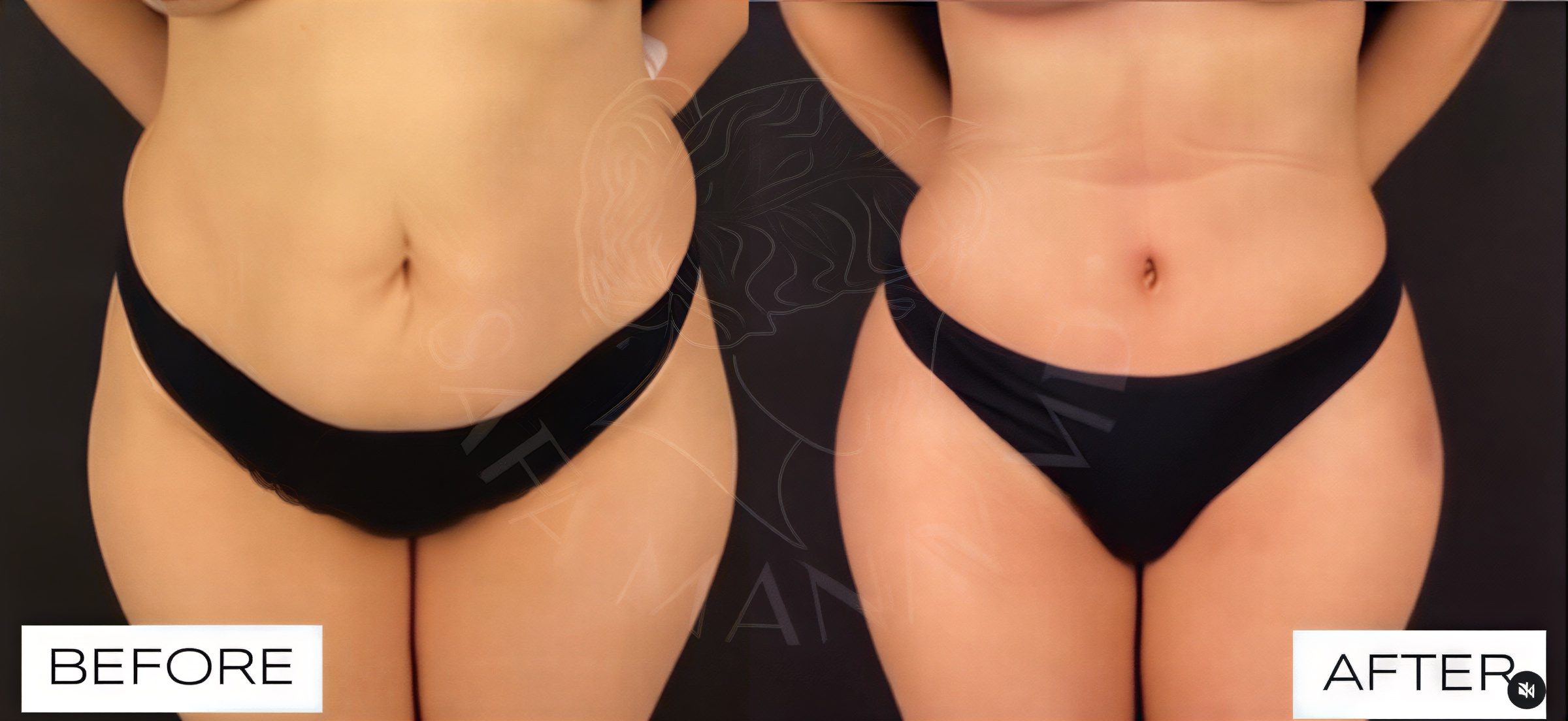 Resultados de liposucción 360 antes y después en Dr. Safa Manav Clinic, contorno mejorado
