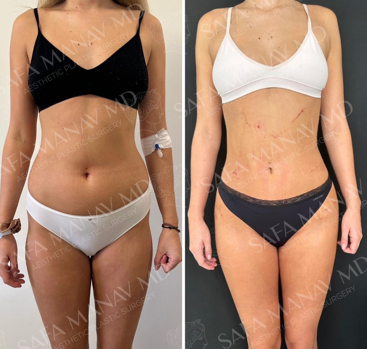 360-Liposuktion Vorher-Nachher-Ergebnis bei Dr. Safa Manav Clinic, sichtbare Körperkontur