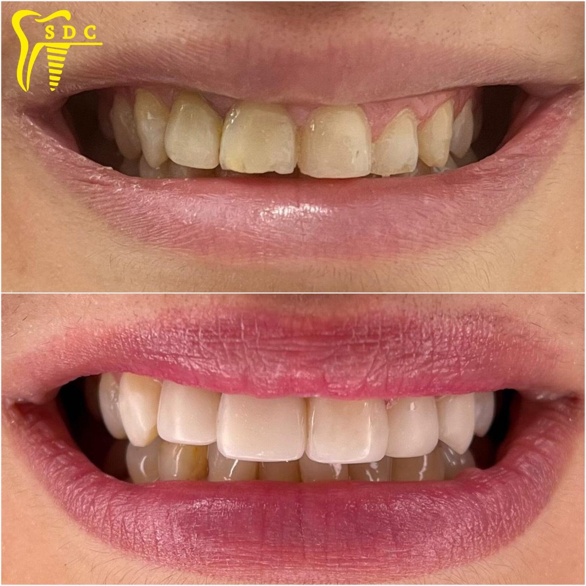 نتيجة قبل وبعد الفينير في عيادة Spanderashvili Dental Clinic، تحول ملحوظ للابتسامة