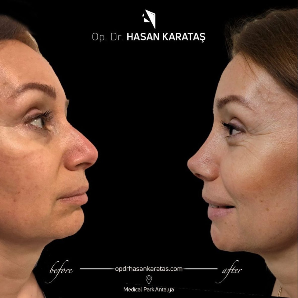 Before and after ultrasonic rhinoplasty results at Medical Park Antalya Hospital Complex