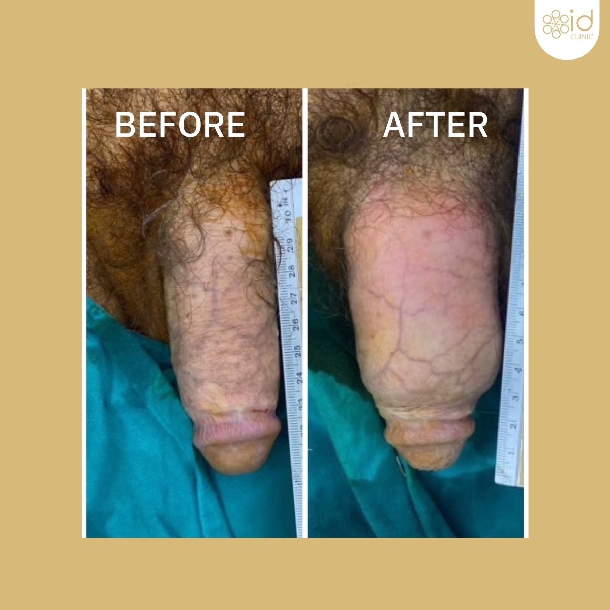 Before and after penis filler results at ID Clinic Bangkok, visible girth enhancement procedure