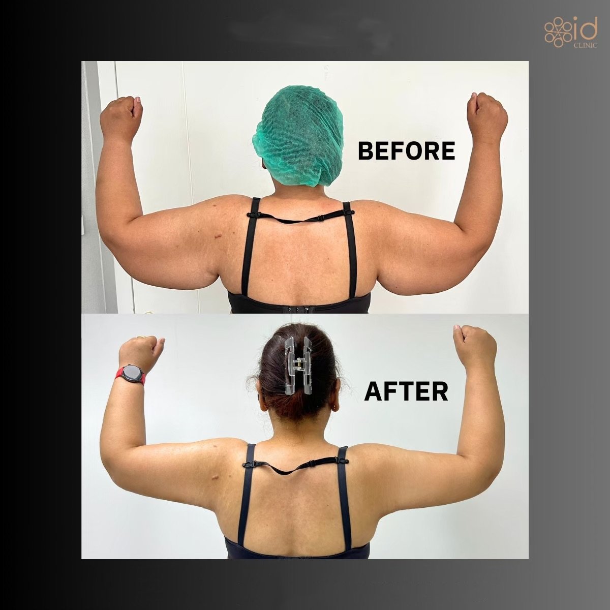 Before and after Vaser liposuction arm contouring results at ID Clinic Bangkok