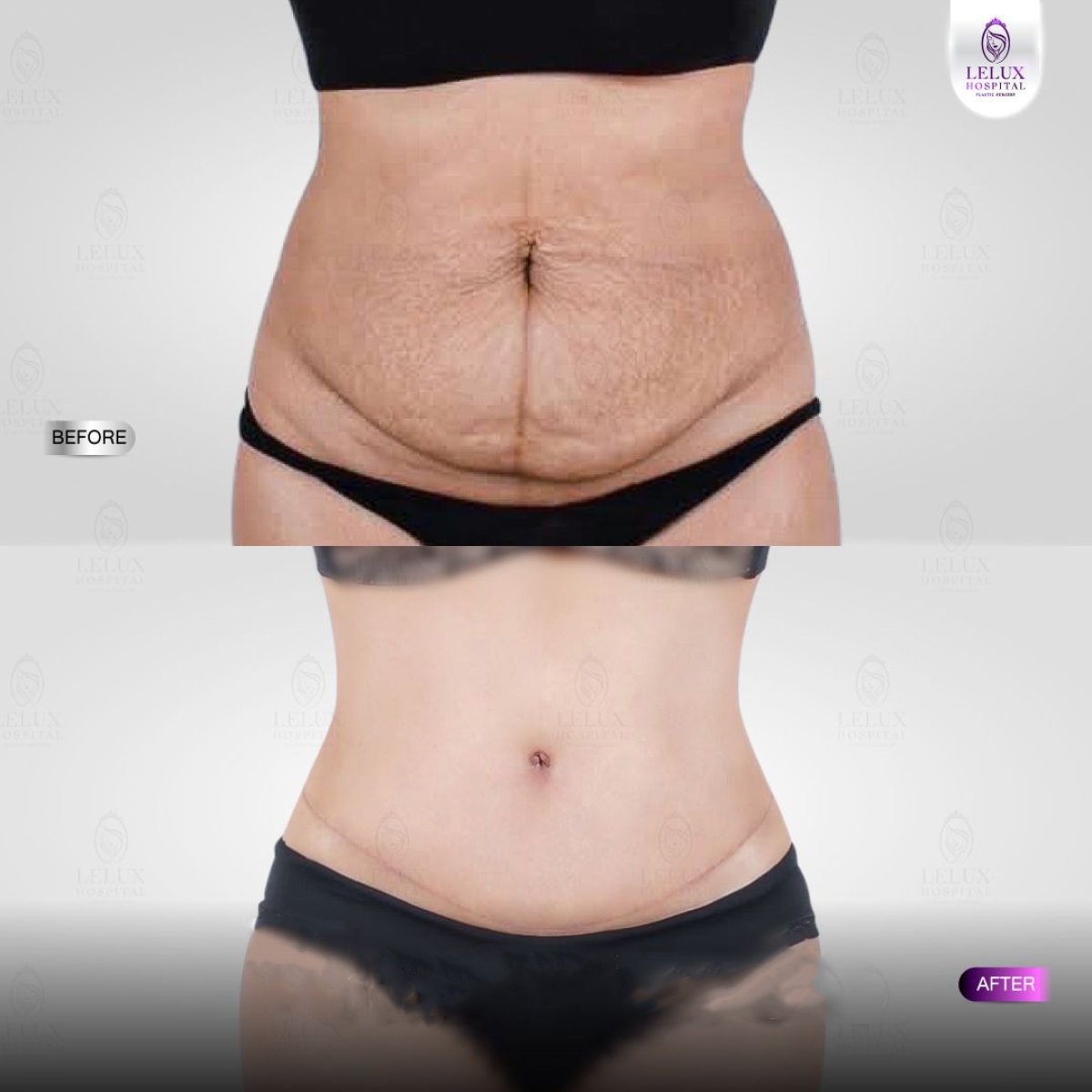 Resultados de abdominoplastia antes y después en Lelux Hospital con mejor contorno abdominal