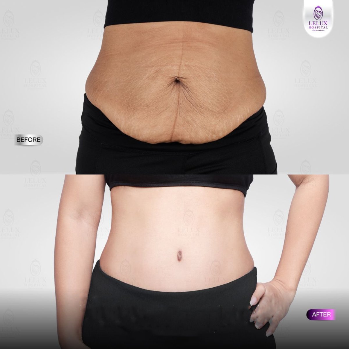 Resultados de abdominoplastia antes y después en Lelux Hospital – abdomen y piel mejorados
