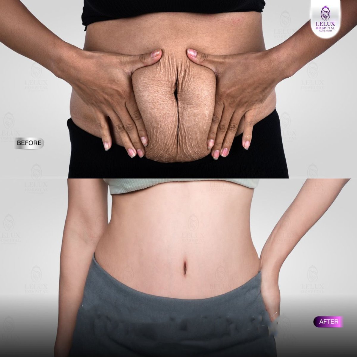Before and after tummy tuck at Lelux Hospital – visible abdominal contour improvement result
