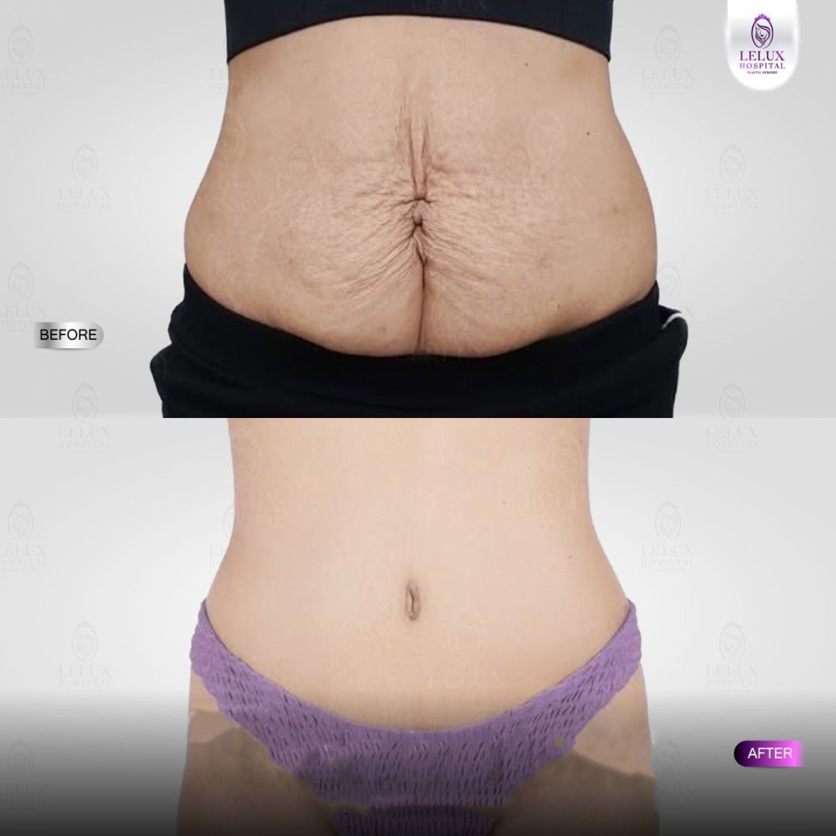 Before and after tummy tuck results at Lelux Hospital – improved abdominal contour and skin