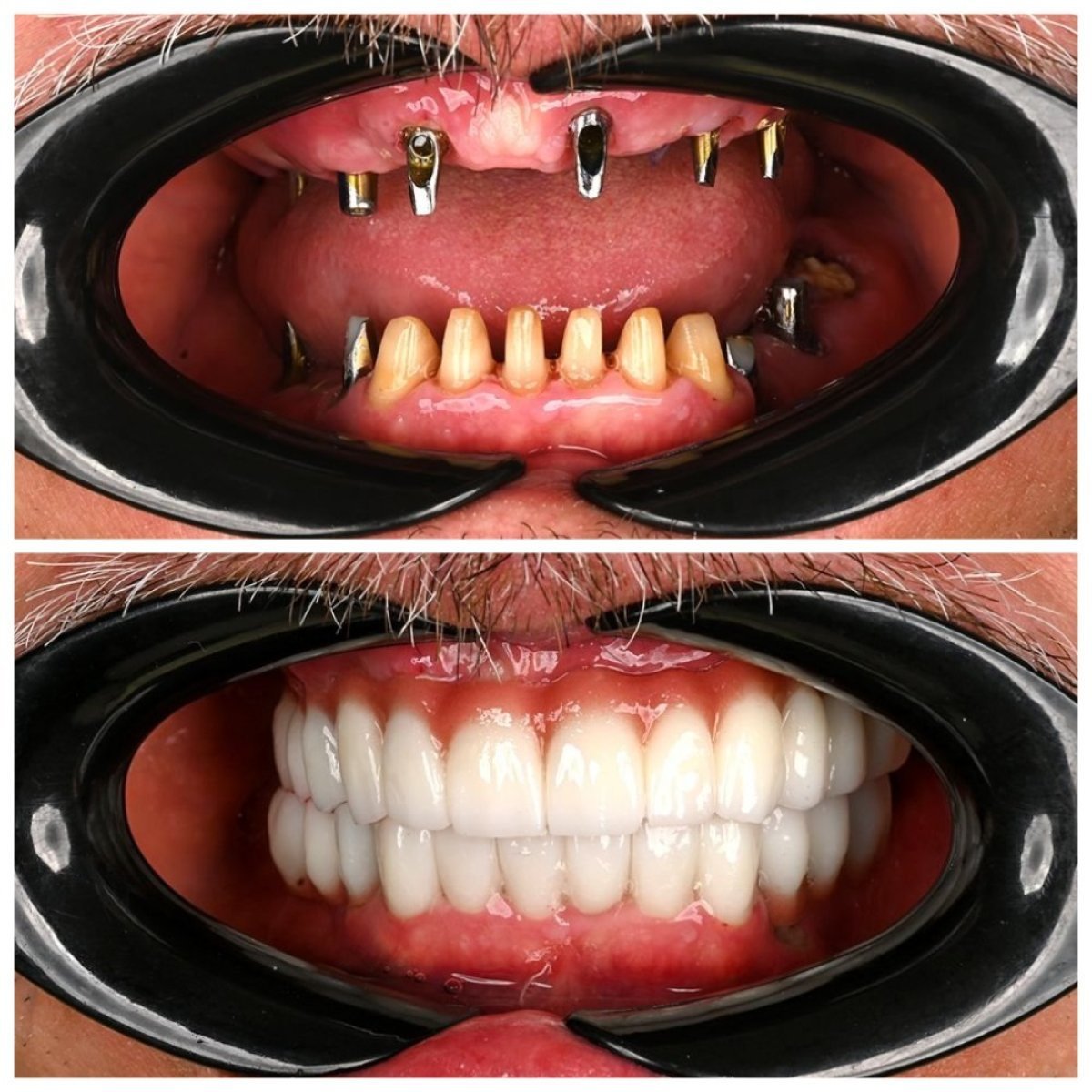 Before and after dental prosthetics installation at Soraca Med, full smile restoration result
