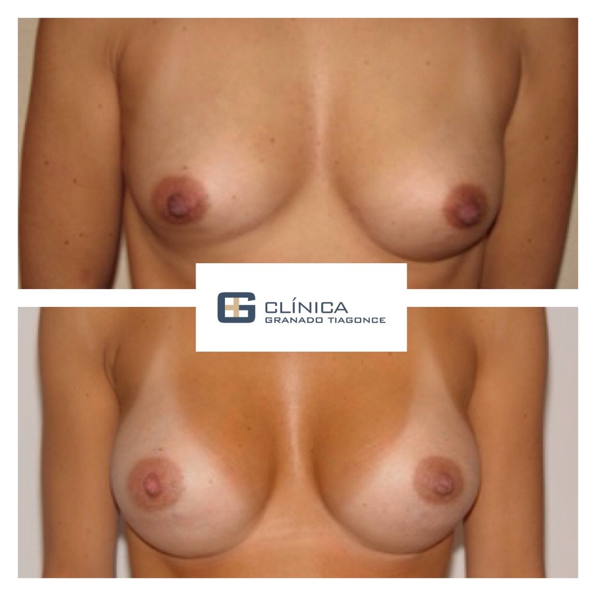 Before and after breast augmentation results at Clinica Granado Tiagonce, enhanced breast shape
