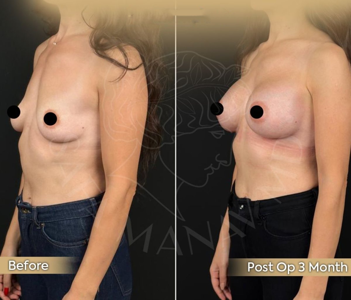 Résultats avant et après augmentation mammaire à la clinique Dr. Safa Manav, 3 mois post-op