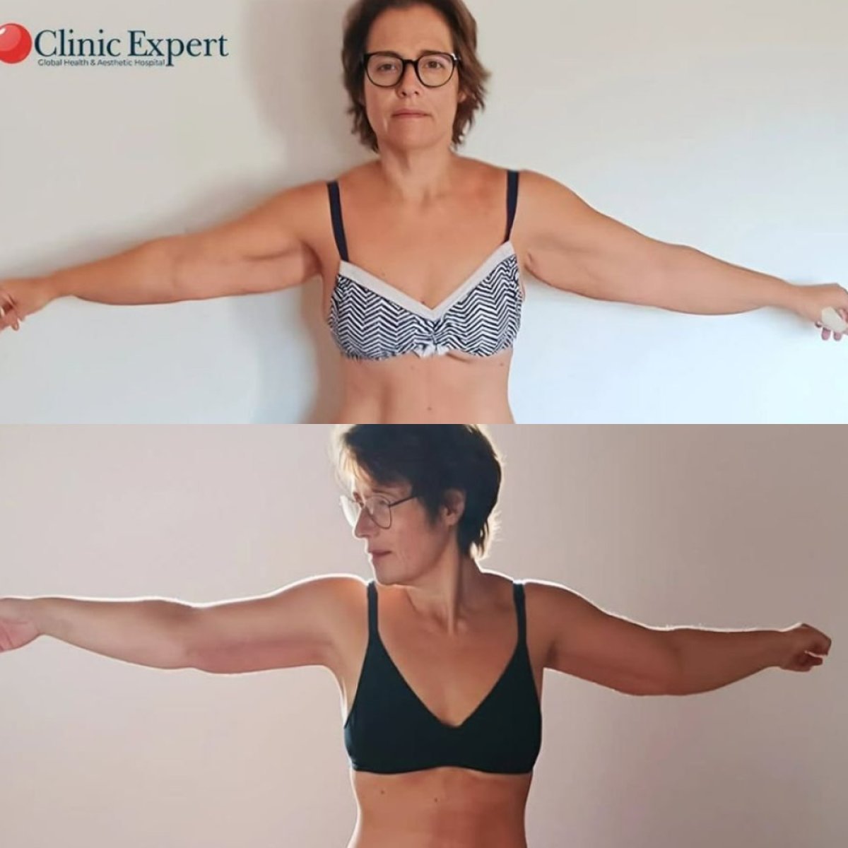 Resultados de liposucción de brazos antes y después en CE International Hospital, brazos más delgados