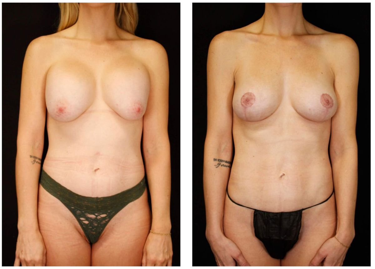 Результаты до и после подтяжки груди в Dr. Alexandro Aguilera - Plastic Surgery, улучшенный контур