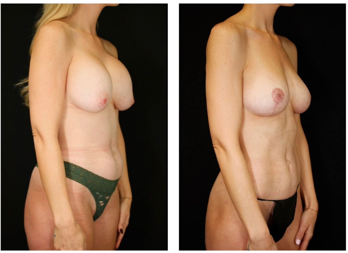 نتائج شد الثدي قبل وبعد في Dr. Alexandro Aguilera - Plastic Surgery، تحسين الشكل