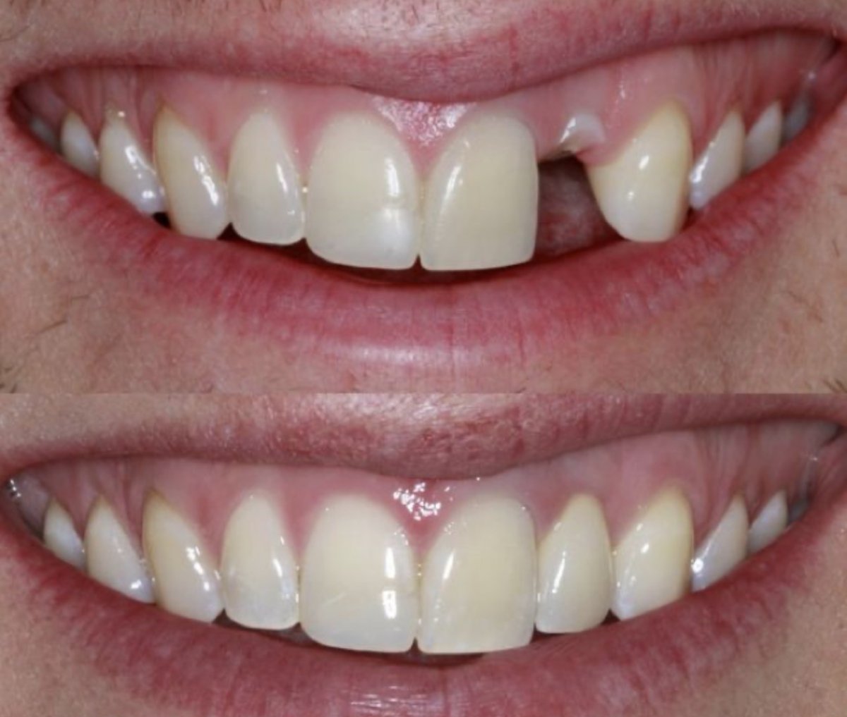 Before and after dental implant result at Love Dental and Sthetic Clinic for missing tooth restoration